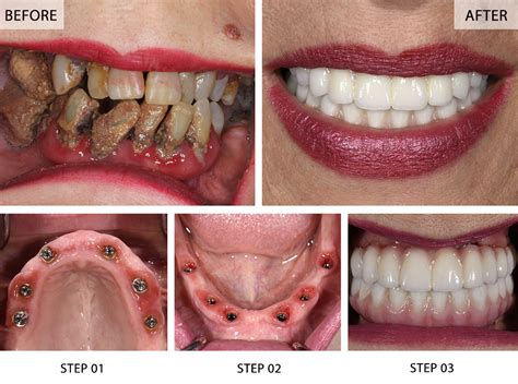 full-mouth implant in kent
